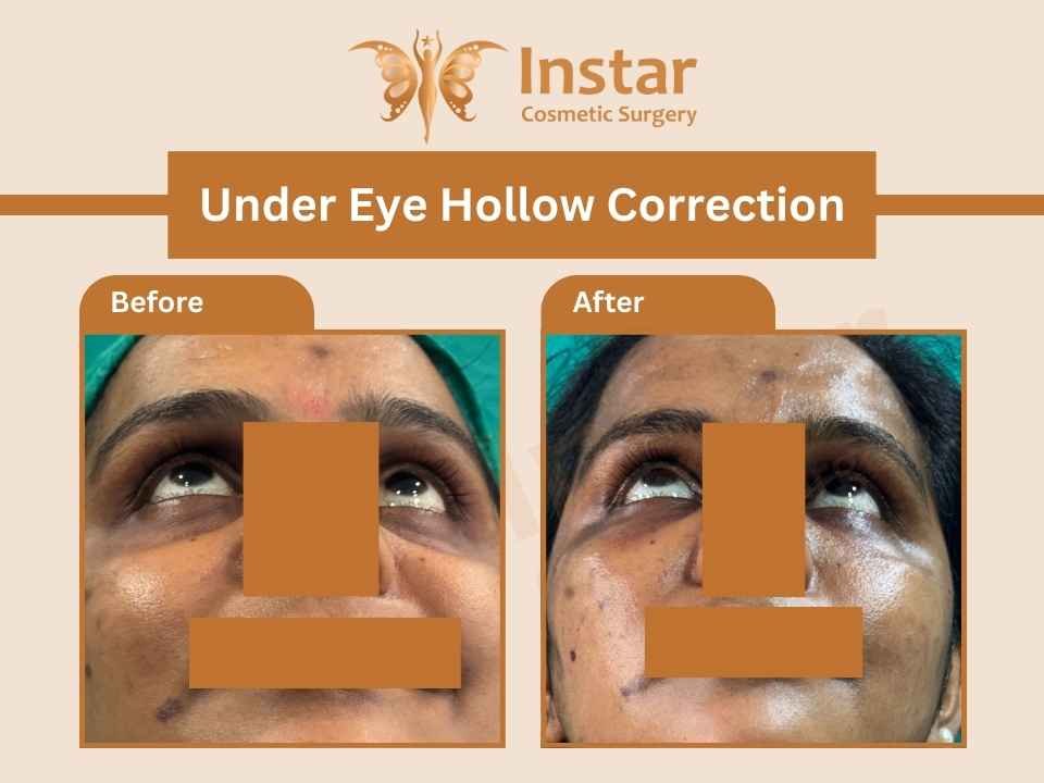 Under-Eye-Hollow-Correction-2 (1)